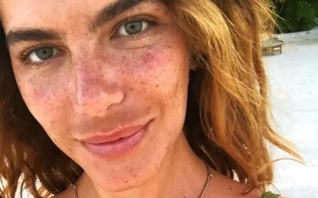 Zwangerschapsmasker behandeling in Amsterdam Avoria